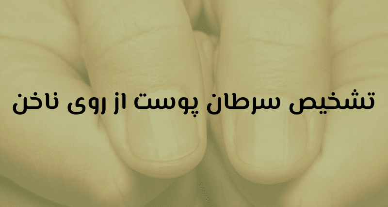 تشخیص سرطان پوست از روی ناخن‌
