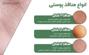 انواع منافذ پوستی